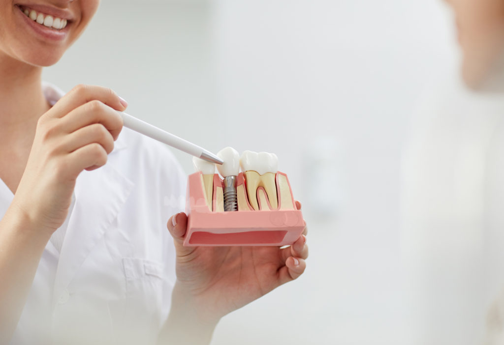 Dentista aponta para prótese colocado sobre um implante de titânio em uma estrutura demonstrativa. O procedimento pode fazer parte da Reabilitação Oral.